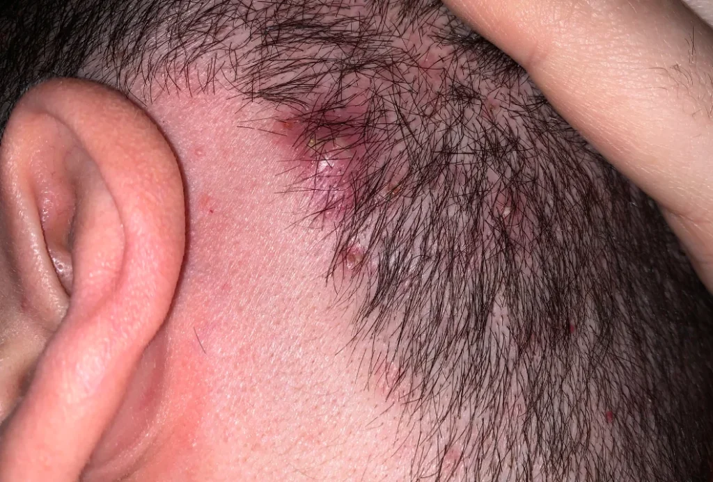 Acne Ive Had What I Think Is Scalp Acne On And Off For V0 Gi9kz6au536a1 1024x693.webp